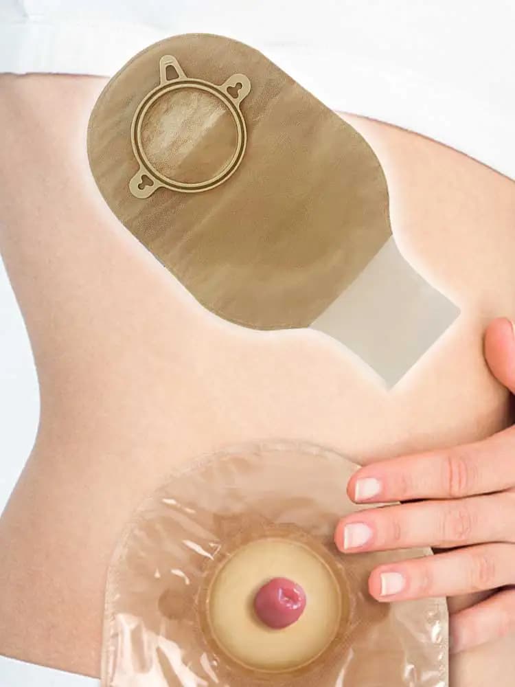 Veel barrièretassen, stomazakjes, colostomiezakjes, drainable zakjes met ring, ileostomie, stomaverzorging
