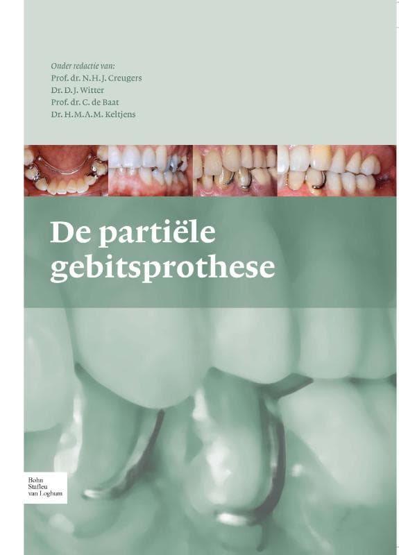 De partiele gebitsprothese (Hardback)